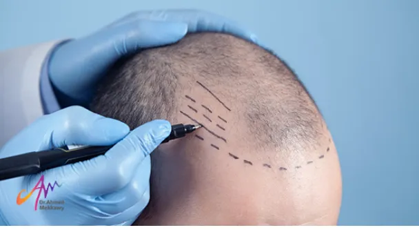 افضل ادوية لتساقط الشعر والصلع المبكر‎