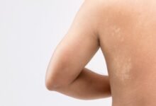 أفضل علاج للسعفة من الصيدلية