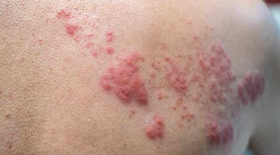 10 معلومات عن استخدامات شراب وكريم زوفيراكس لعلاج الهربس والآثار الجانبية 1 يعالج زوفيركس آثار فيروس الهربس