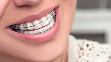 تقويم الأسنان قبل وبعد: كل ما تحتاج معرفته للحصول على ابتسامة مثالية