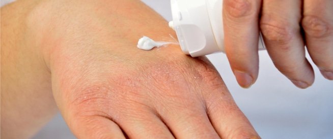 أسباب الحاجة إلى استخدام كريم الحرق