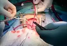 تجربتي مع عملية القلب المفتوح