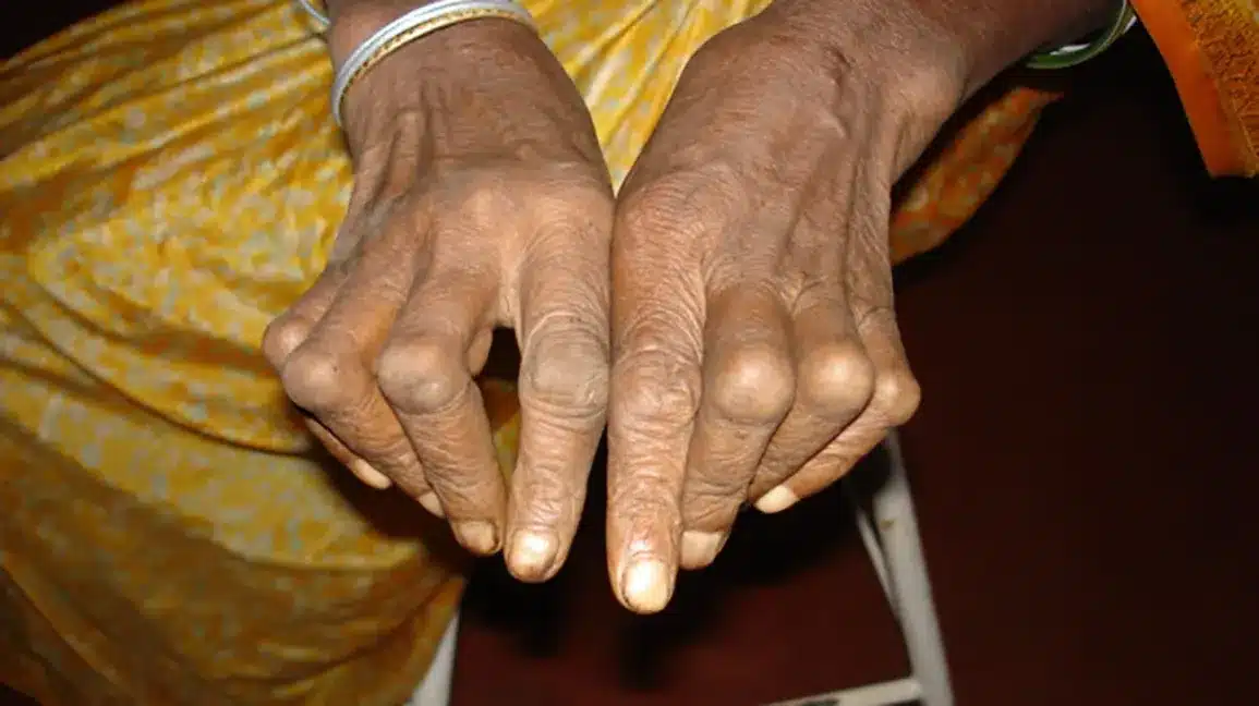 رجل يعاني من ألم وتورم في مفاصل اليدين بسبب التهاب المفصل الروماتويدي، يمسك بيده المتألمة بحذر